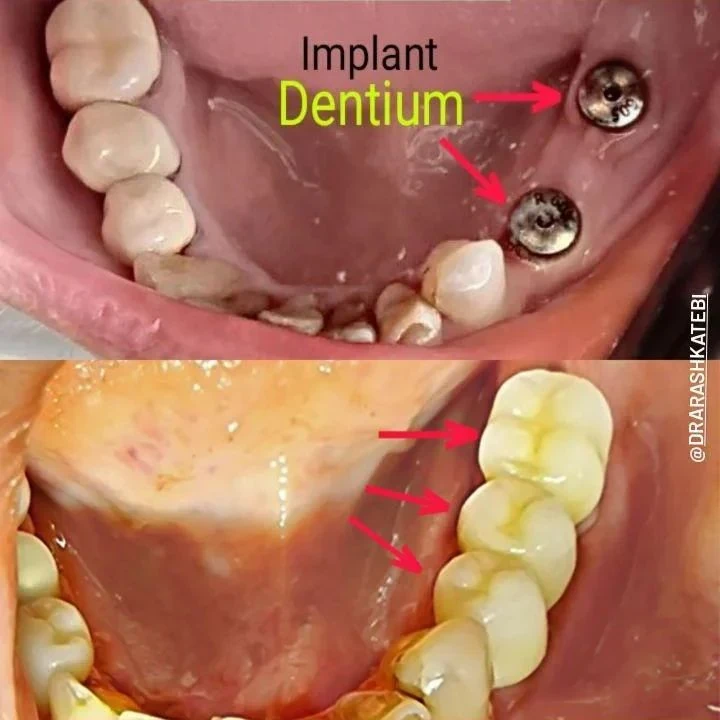 دندانپزشکی زیبایی و ایمپلنت دکتر آرش کاتبی