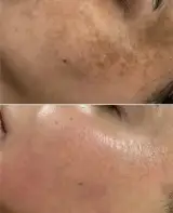 فشیال و پاکسازی پوست آیسودا رضایی