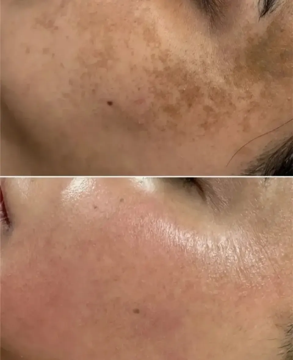 فشیال و پاکسازی پوست آیسودا رضایی