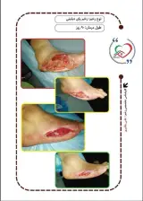 تیم تخصصی درمان زخم خانه سلامت