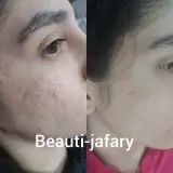 فیشال، پاکسازی و کربوکسی صبا جعفری