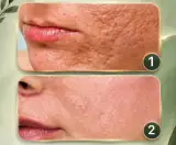 لیزر CO2 فرکشنال برای جای جوش و سوختگی در بهشت مشهد