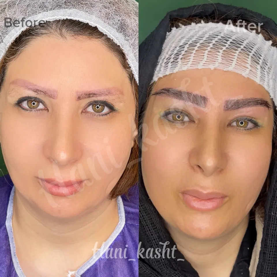 مرکز تحصصی کاشت ابرو حانی کاشت