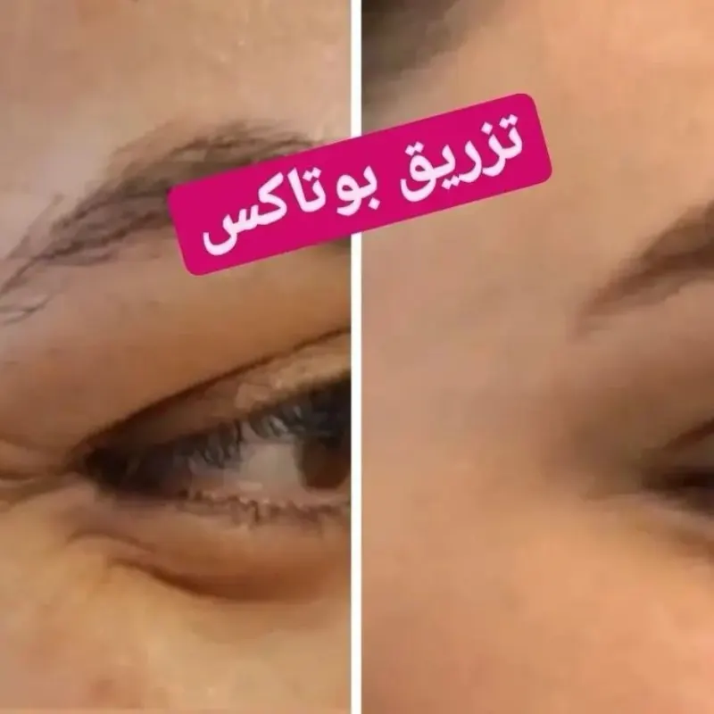 تزریق فیلر و بوتاکس لیزرموهای زائد