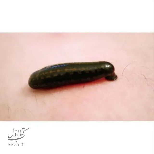 زالو درمانی گلپا