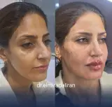 خدمات زیبایی ژل لب توسط پزشک