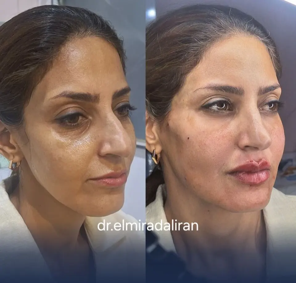 خدمات زیبایی ژل لب توسط پزشک