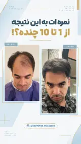 کاشت مو و ابرو آویس