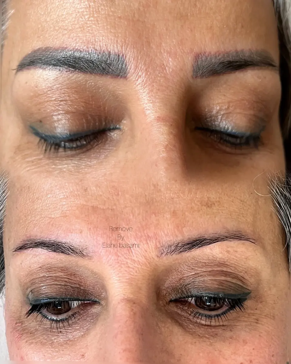 کلینیک تخصصی حذف تاتو در اصفهان