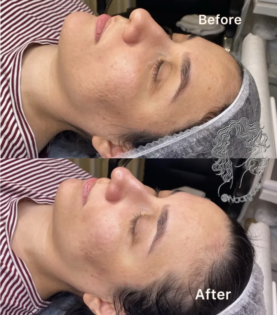 فیشال و پاکسازی تخصصی پوست نرگس