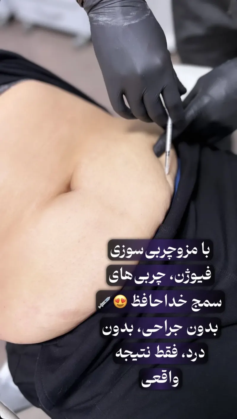 کلینیک زیبایی،لاغری لمیس