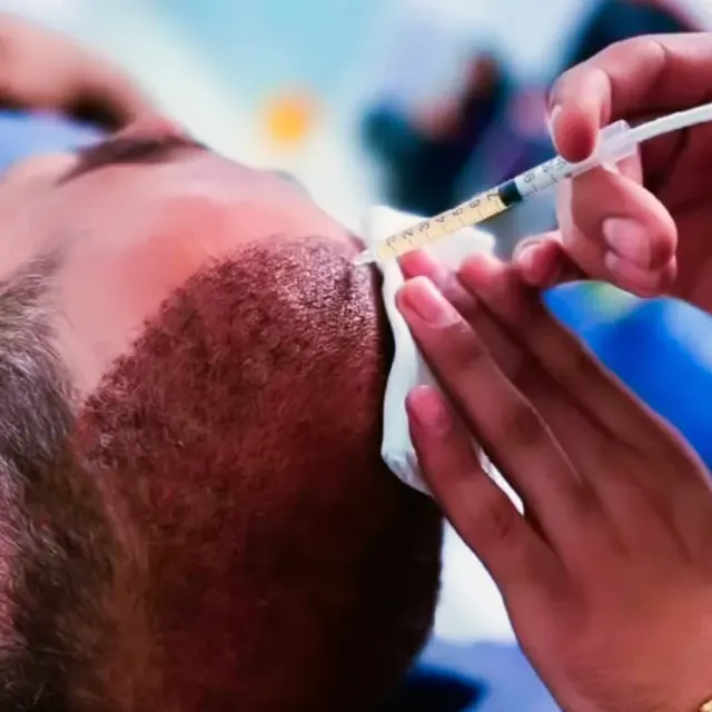 کارشناس کاشت مو مهدی سلطانی