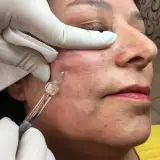 آموزش هایفو و لیزر و فشیال و ماساژ