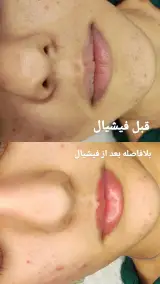 فیشیال تخصصی و پاکسازی پوست رادیانس
