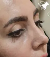 جراحی زیبایی بینی-دکتر مهدی فانی-خرم آباد