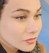 عمل بینی شیراز/لیفت شقیقه شیراز/لیفت شقیقه