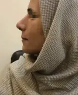 جراحی بینی/عمل بینی/دکتر ندا سخی