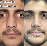جراحی بینی کرج دکتر سارا پذیرا