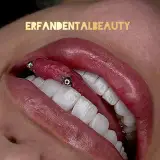 دندانپزشکی عرفان | کامپوزیت | لمینیت  به صورت تخصصی