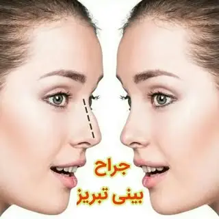 ? جراحی بینی تبریز ?