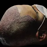 کاشت مو و کاشت ابرو علی جعفری