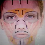 Botox-دکتر گلستان