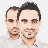 کاشت موی اردبیل شیراز