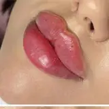 ?تزریق ژل و بوتاکس خرم آباد?