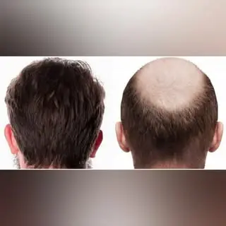 کلینیک های کاشت مو مشهد