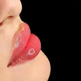 ژل لب،بوتاکس،فیلربینی،نخ لیفت