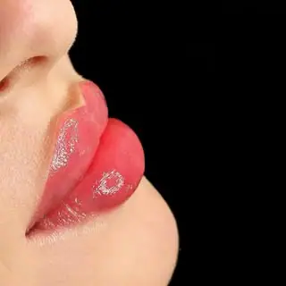 ژل لب،بوتاکس،فیلربینی،نخ لیفت