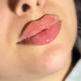 تزریق ژل و بوتاکس بوشهر در كلينيك آريانا