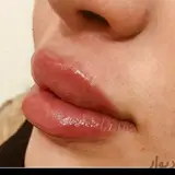 تزریق ژل و بوتاکس .شیراز