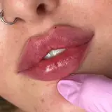 تزریق ژل و بوتاکس