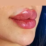 فیلر لب/بوتاکس/کانتورینگ صورت/هایفو/جوانسازی صورت/ارومیه