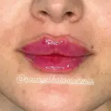 کلینیک تزریق ژل،بوتاکس ارومیه?