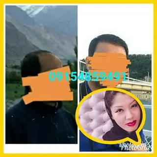 کاشت مو مشهد ؛بجنورد