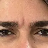 خانه بوتاکس رشت، دکتر دلیری، ژل، فیلر، مزوژل،پروفایلو