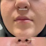 لیزر موی زائد دکتر محمد امید
