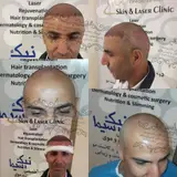 کاشت مو در تبریز