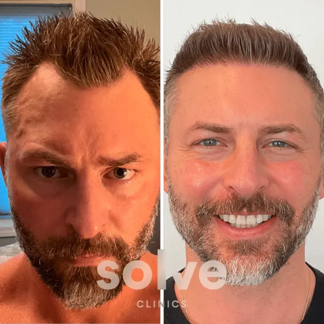 Solve Clinics Hair Transplant New York