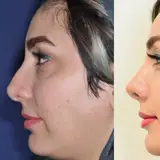 جراح بینی دکتر امید ابراهیمی در تهران