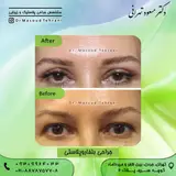 دکتر مسعود تهرانی ، جراح پلک