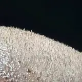 کاشت مو