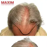 Maxim Hair Restoration & Transplants - New York City