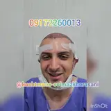 کلینیک کاشت موی طبیعی نیک