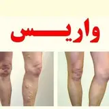 درمان واريس