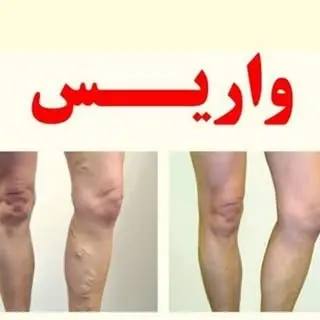 درمان واريس