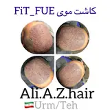 کاشت موی تک(علی علیزاده )ارومیه /تهران