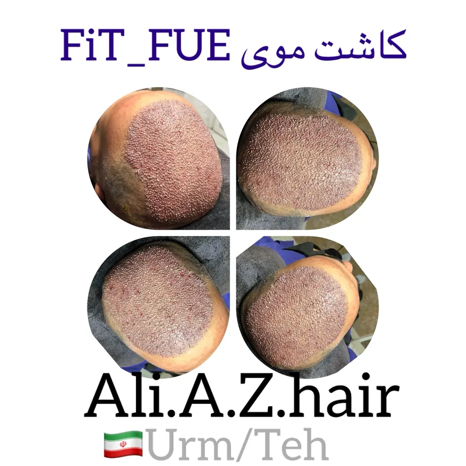کاشت موی تک(علی علیزاده )ارومیه /تهران